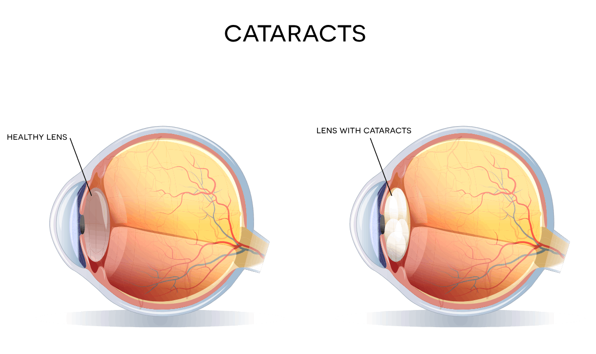 Demonstration of cataract anatomy