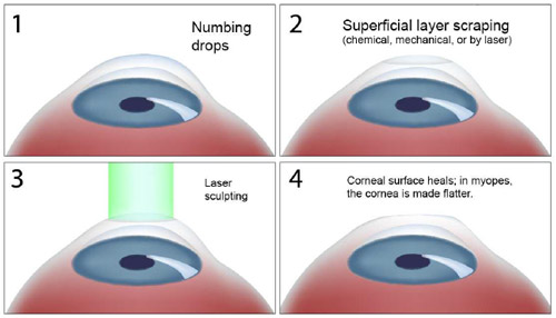 Steps of LASIK surgery diagram