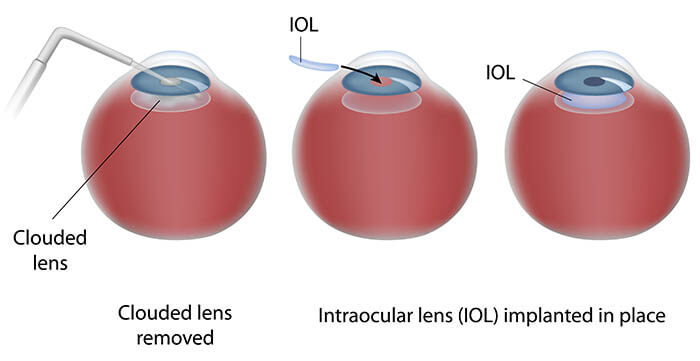 Chart Illustrating the Cataract Surgery Process