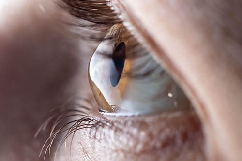 Closeup of an Eye Experiencing Keratoconus